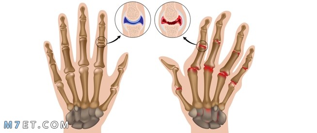 هل مرض الروماتيزم خطير