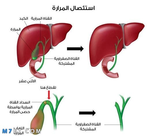 اعراض التهاب المرارة