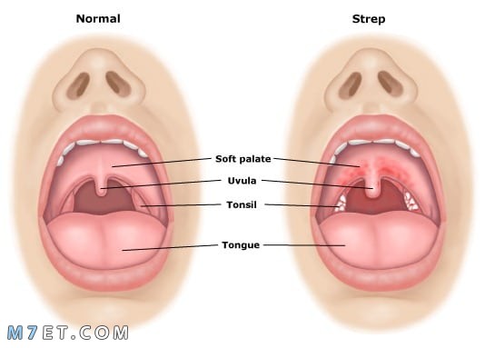 علاج التهاب الحلق