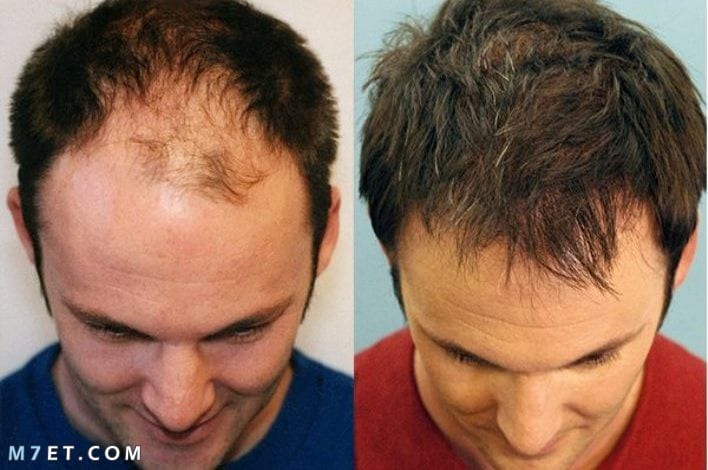 تكلفة زراعة الشعر في مصر