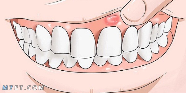 علاج التهاب اللثة