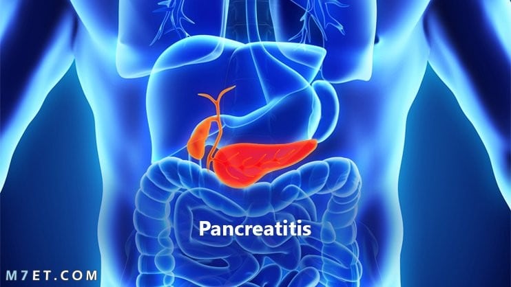 التهاب البنكرياس