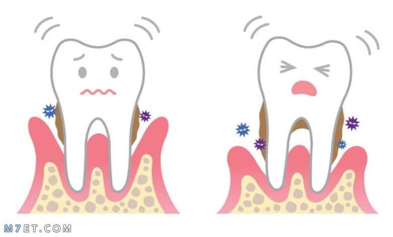 علاج التهاب اللثة بالمره
