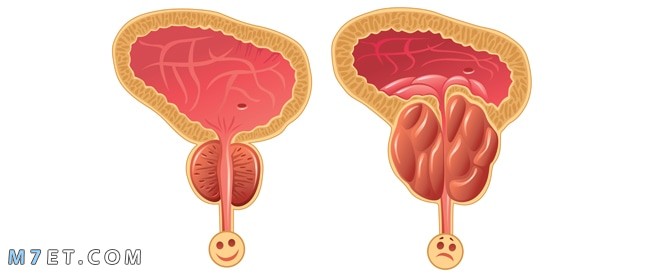 اعراض البروستاتا عند الرجال