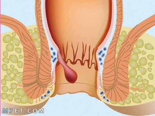 اعراض البواسير الخارجية