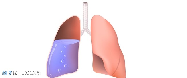 الماء على الرئة