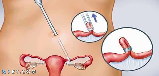 ربط الرحم| كل ما يتعلق بهذه العملية | الاسباب والاضرار صورة رقم 1