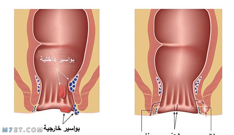 التهاب الناسور