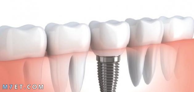 الفرق بين زراعة الأسنان وتركيب الأسنان