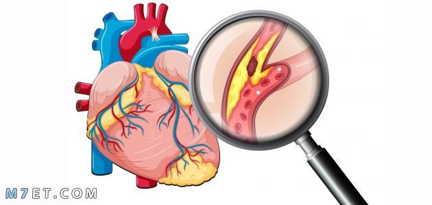 علاج شريان الابهر