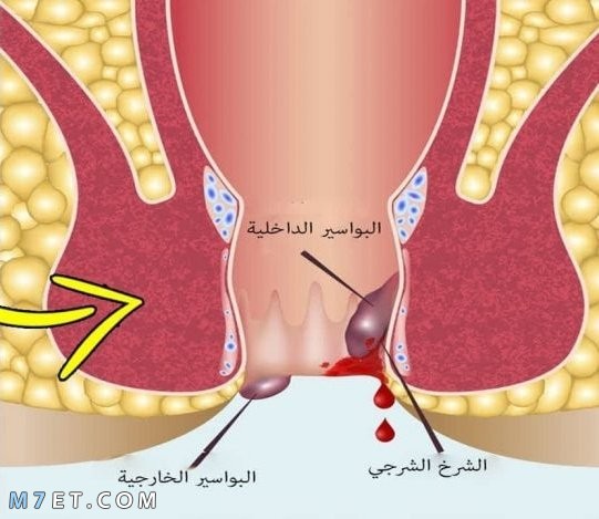 أفضل علاج للشرخ