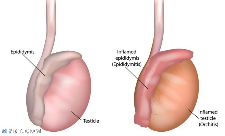 أسباب الم في الخصية اليسرى صورة رقم 1