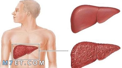 Photo of التهاب الكبد | أنواع التهاب الكبد واعراضها