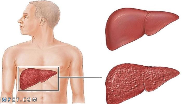 التهاب الكبد