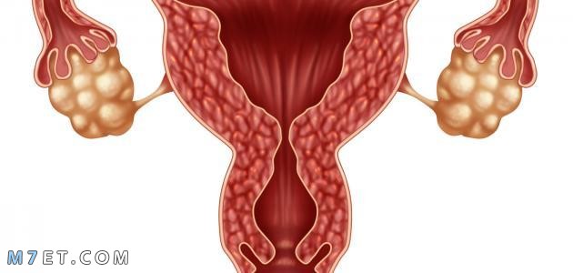 أدوية علاج تضخم الرحم بالأعشاب