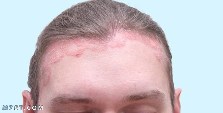 عيوب زراعة الشعر بالاقتطاف