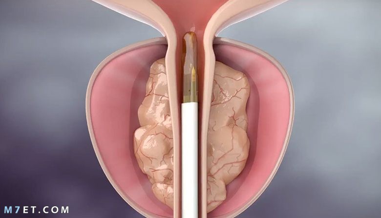  تجربتي مع احتقان البروستاتا