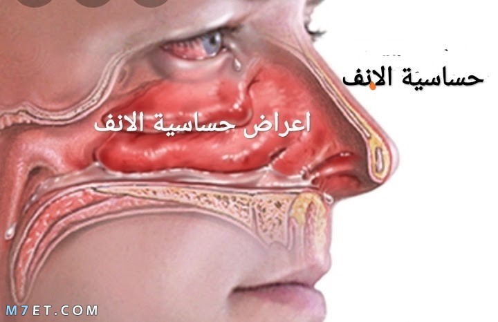 علاج حساسية الأنف نهائيًا