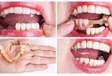 Photo of معلومات تفصيلية عن تركيب الأسنان الأمامية