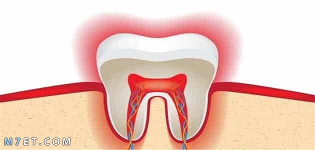 كيفية تمويت عصب الضرس في المنزل