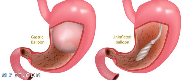 أضرار بالون المعدة