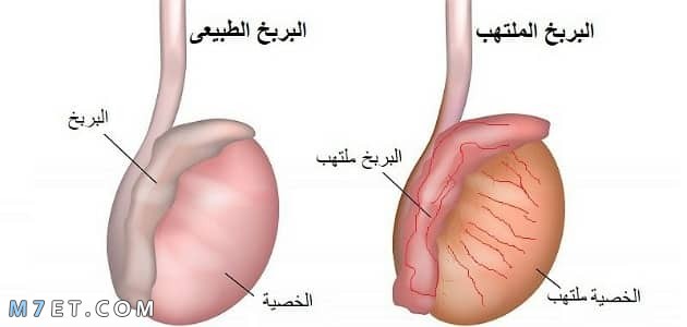 ضمور الخصية