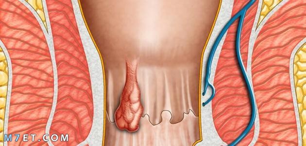 أسباب البواسير عند الرجال
