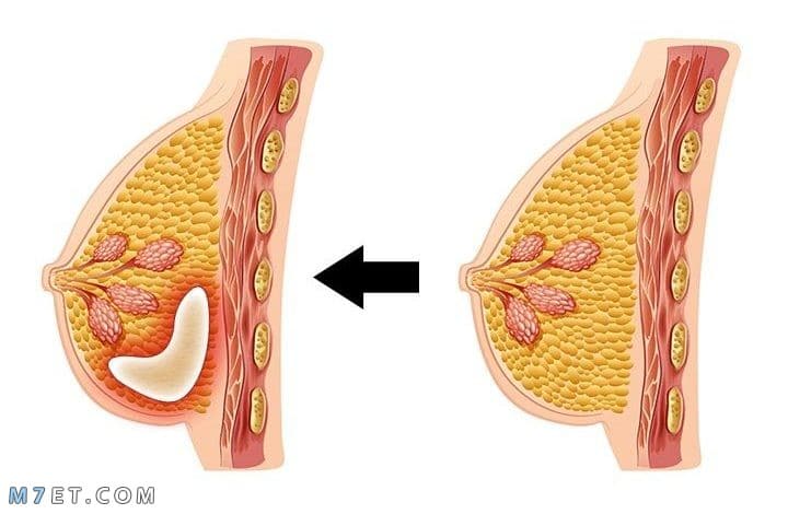تجربتي مع التهاب الثدي 