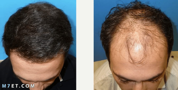 تجربتي مع زراعة الشعر