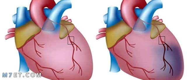 الذبحة الصدرية | ما هي أعراضها وكيفية تشخيصها وما هي الإسعافات الأولية الخاصة بها