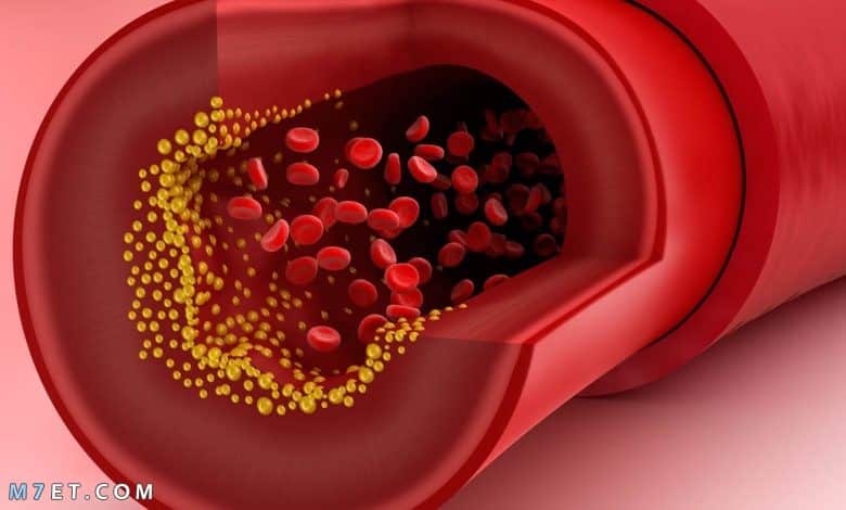 أعراض ارتفاع الدهون الثلاثية والكوليسترول