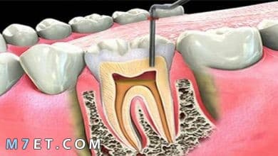 Photo of ما التقنيات المستخدمة في علاج الضرس المحفور