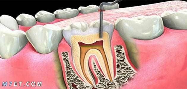 علاج الضرس المحفور