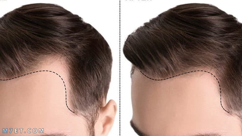 اسعار زراعة الشعر