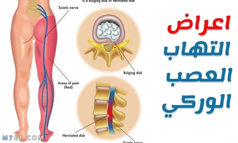 أعراض العصب الوركي