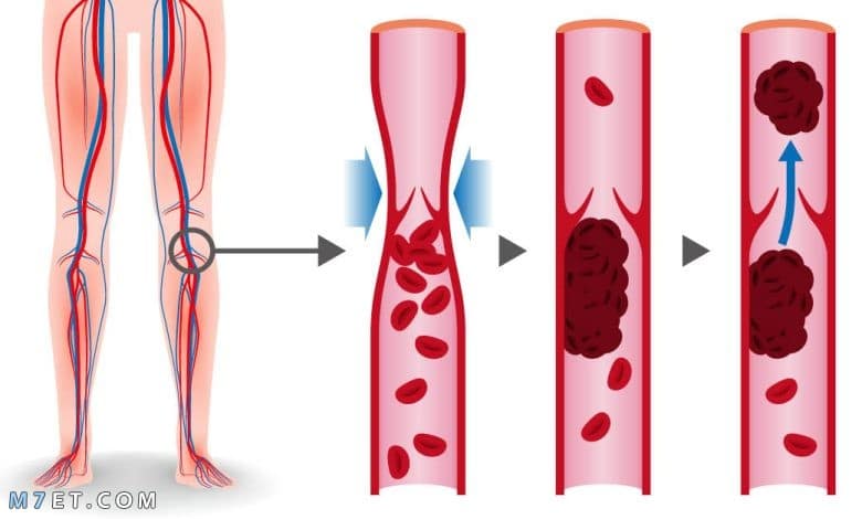 الجلطة في الرجل