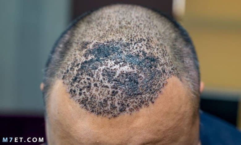 تجربتي مع زراعة الشعر في مصر 