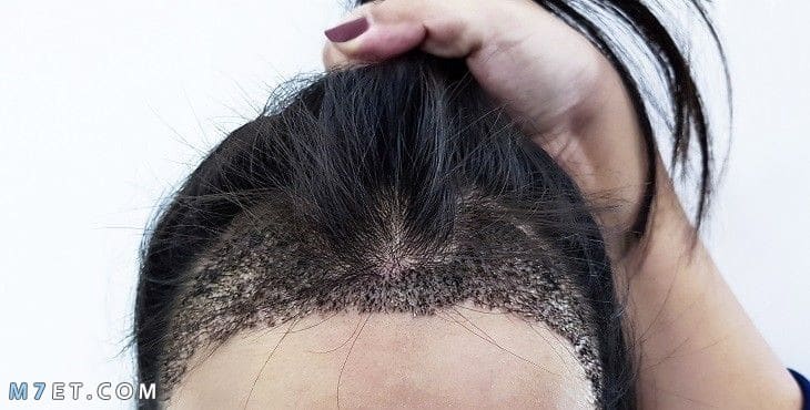 زراعة الشعر بالتقسيط في مصر