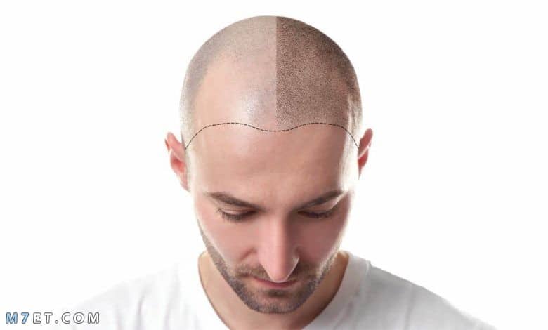 ما هو أفضل مركز لزراعة الشعر في تركيا