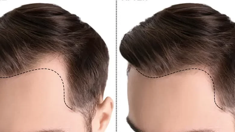 تكلفة زراعة الشعر في دبي