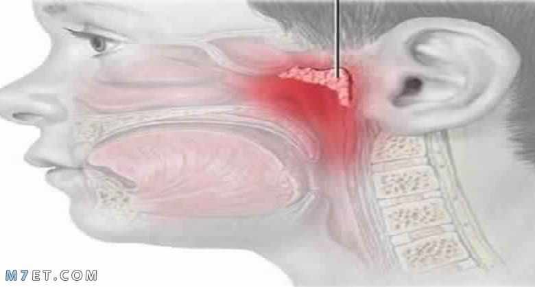 أعراض انسداد قناة استاكيوس