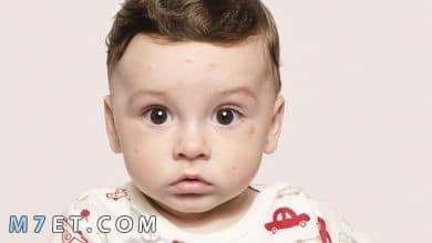 Photo of ما هو علاج البقع البيضاء في الوجه للاطفال