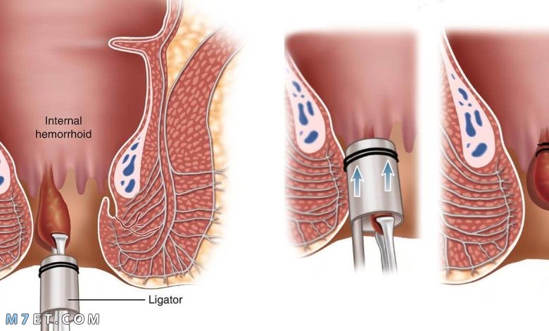 متى يلتئم الجرح بعد عملية البواسير