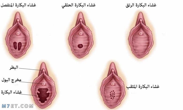 مدة شفاء جرح البكارة