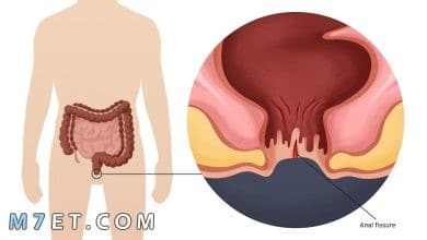 Photo of مرهم لعلاج الشرخ | أفضل المراهم الطبية المعالجة للشرخ الشرجي