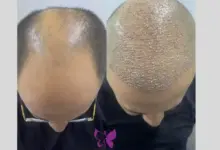 Photo of أسعار زراعة الشعر في مصر 2025