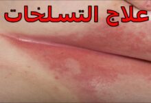 Photo of علاج التسلخات في المناطق الحساسة للنساء في المنزل