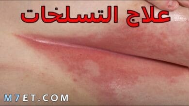 Photo of علاج التسلخات في المناطق الحساسة للنساء في المنزل