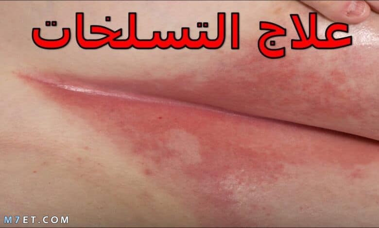 علاج التسلخات في المناطق الحساسة للنساء في المنزل