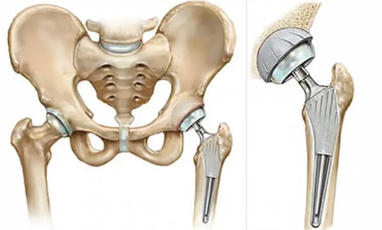 ما هي مراحل شفاء بعد عملية مفصل الحوض